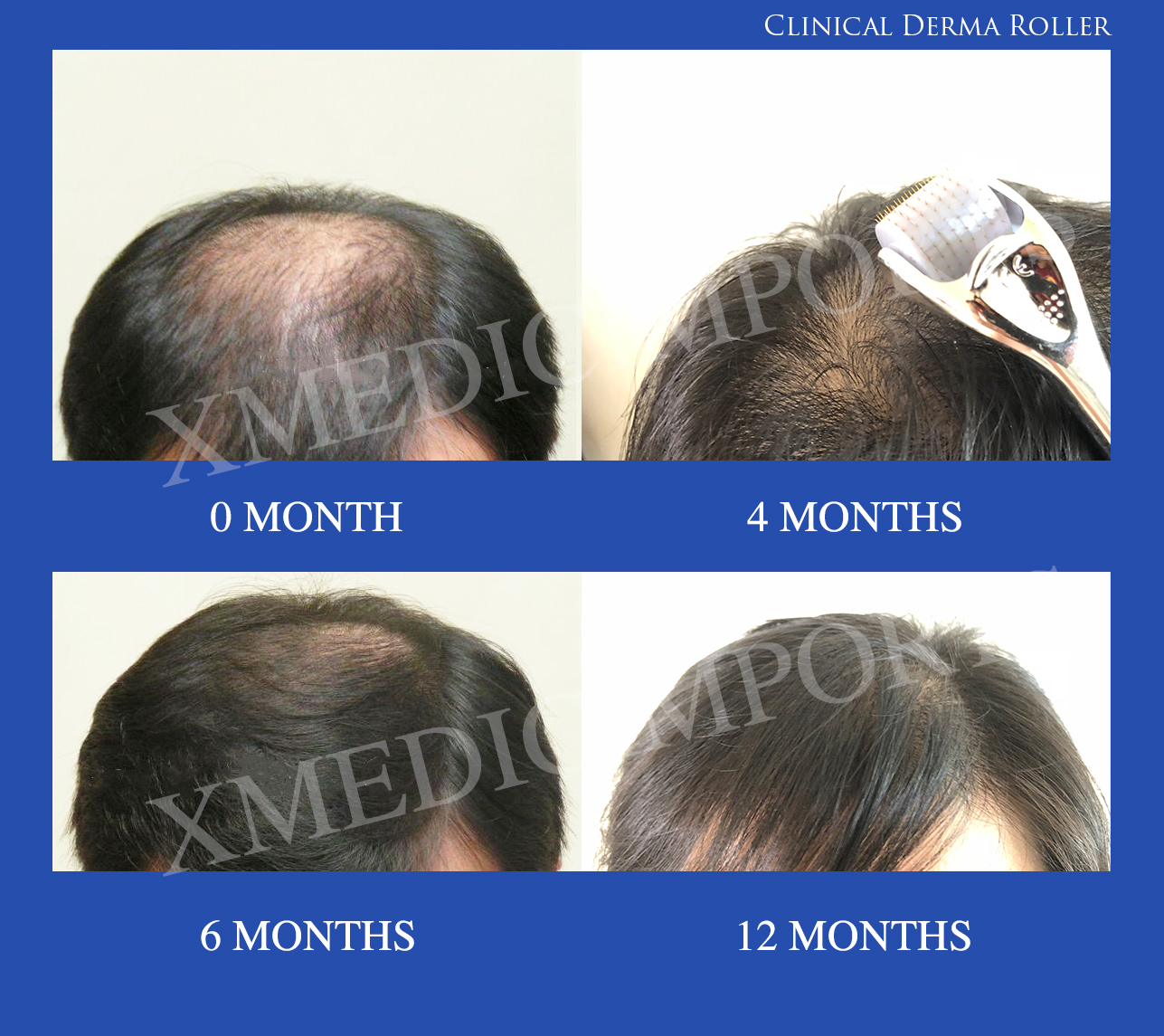 PART 2- Microneedling / Derma roller and pen for hair loss